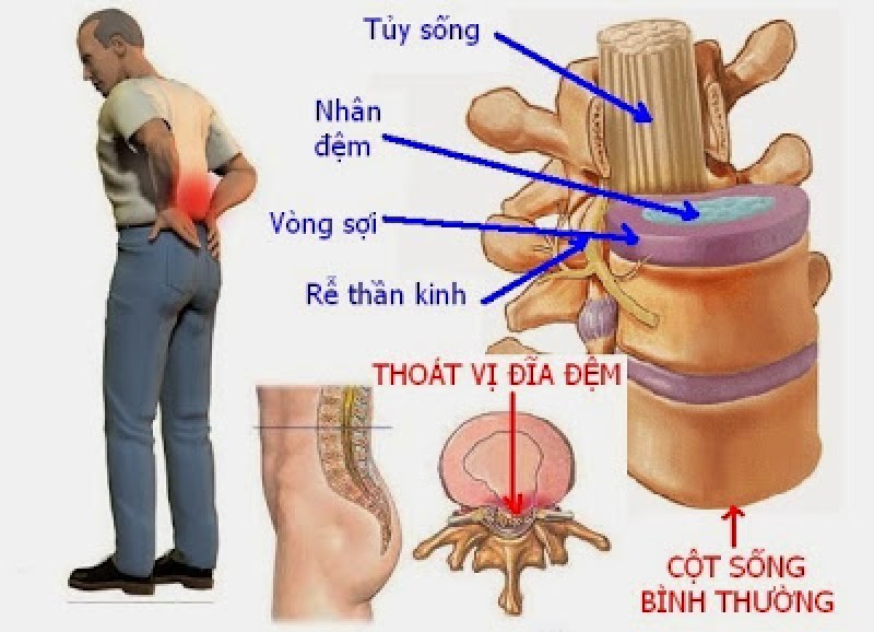 dieu-tri-thoat-vi-dia-dem-bang-cach-massage-bam-huyet-2